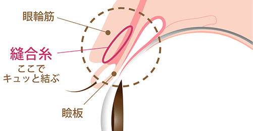 ピュアシークレットダブル法