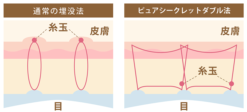 従来の埋没法との違い