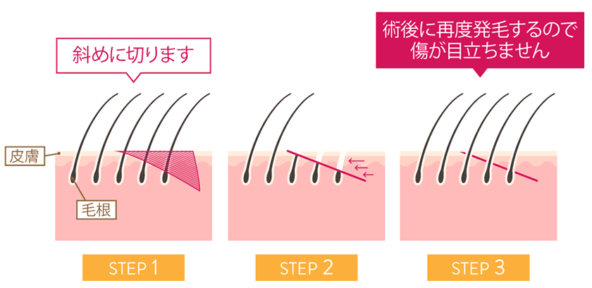 毛包斜断法とは