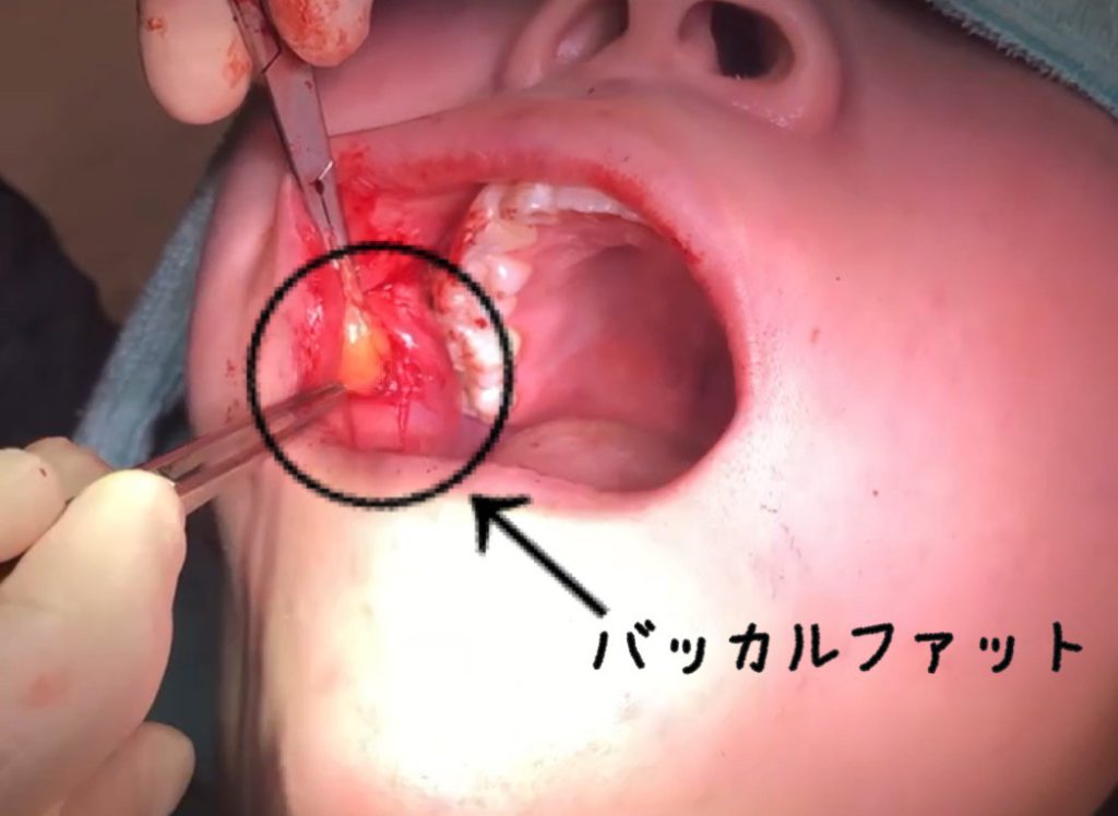 バッカルファット除去 恵比寿 伊勢原の歯医者 歯科 インプラント 矯正 審美歯科 美容外科 美容皮膚科 ピュアグループ