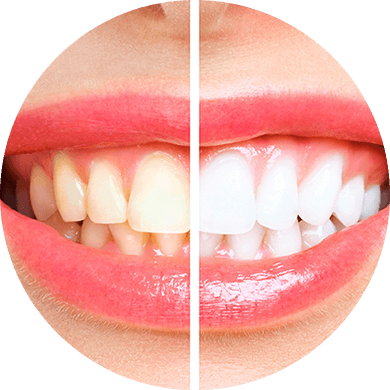 ホワイトニング