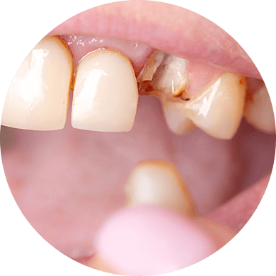 歯がボロボロの方へ