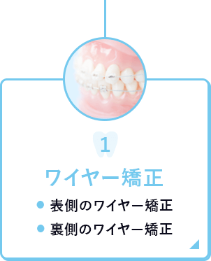 ワイヤー矯正：表側・裏側のワイヤー矯正