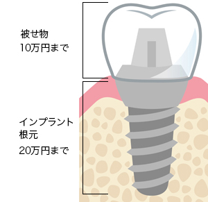 ガイドデント