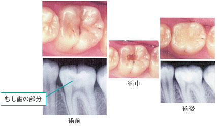 【C2】比較的大きい虫歯