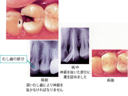 【C3】大きく神経まで到達している虫歯