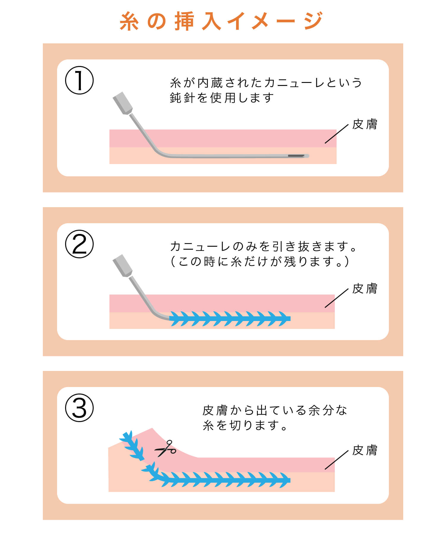 糸の挿入イメージ