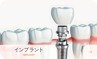 インプラント