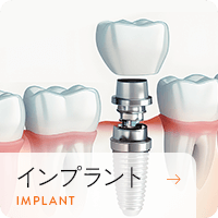 インプラント
