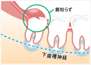 あきらめないで！あなたの親知らず