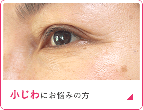 こじわにお悩みの方